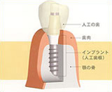 インプラント治療とは