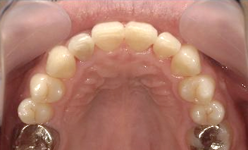 出っ歯を部分矯正で治した症例