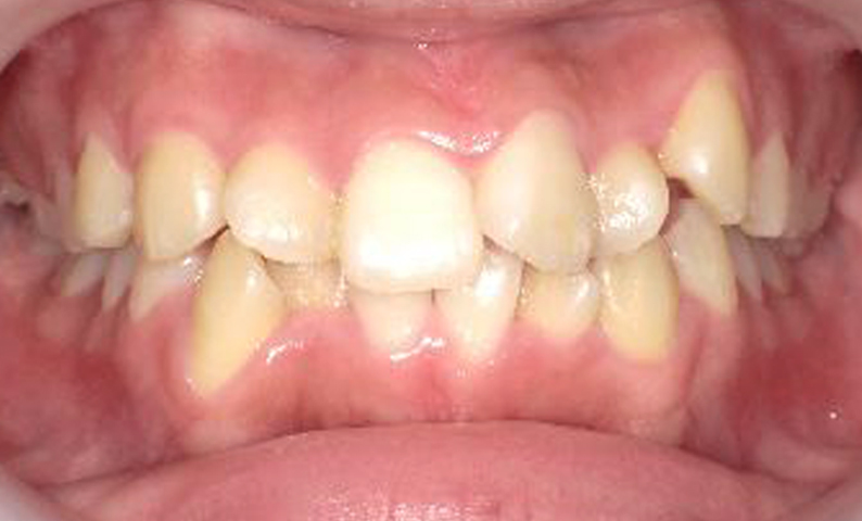 八重歯の症例写真