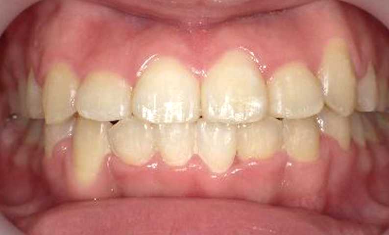 八重歯の症例写真