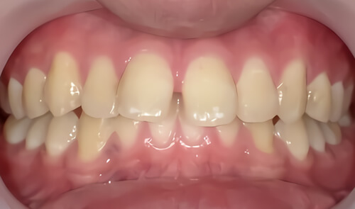 たつや歯科の部分矯正_タイプ別症例集_すきっ歯