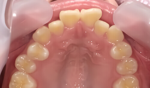 たつや歯科の部分矯正_タイプ別症例集_出っ歯